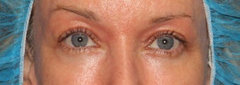 52 year old woman treated with Laser Resurfacing after 2842224