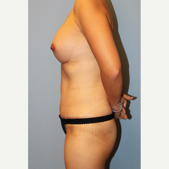 35-44 year old woman treated with Mommy Makeover after 3815665