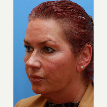 55-64 year old woman treated with Facelift before 3373012