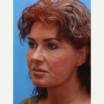55-64 year old woman treated with Facelift after 3373012