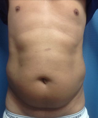 Liposuction of the abdomen on a 45 year old male, 45 days post-op. before 1316930