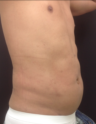 Liposuction of the abdomen on a 45 year old male, 45 days post-op. 1316930
