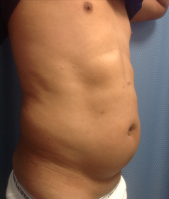 Liposuction of the abdomen on a 45 year old male, 45 days post-op. 1316930