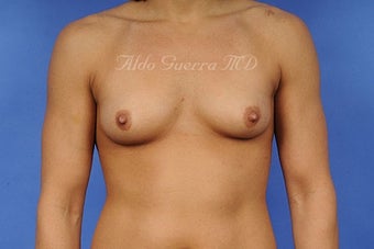 Breast Augmentation Silicone Breast Implants B Cup to D Cup before 698344