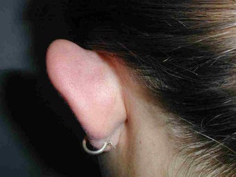 One ear Otoplasty before 108818