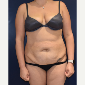 35-44 year old woman treated with Liposuction before 3489807