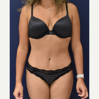 35-44 year old woman treated with Liposuction after 3489807