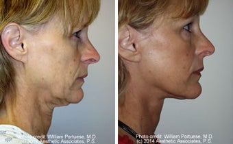 Dermabrasion before 1385308