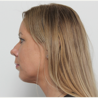 35-44 year old woman treated with Rhinoplasty before 3406138
