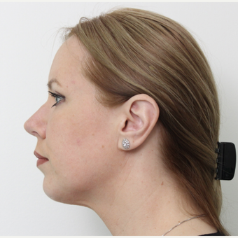 35-44 year old woman treated with Rhinoplasty after 3406138