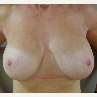 25-34 year old woman treated with Breast Lift with Implants after 3142627