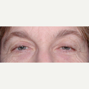 55-64 year old woman treated with Ptosis Surgery before 3042134