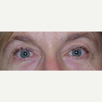 55-64 year old woman treated with Ptosis Surgery after 3042134