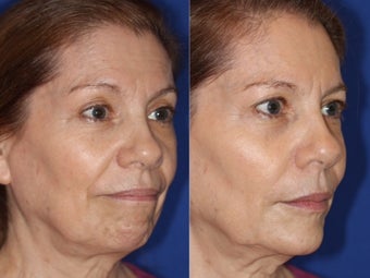 Liquid facelift with cheek and chin augmentation using facial filler after 1460059