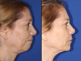 Liquid facelift with cheek and chin augmentation using facial filler 1460059