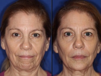 Liquid facelift with cheek and chin augmentation using facial filler before 1460059