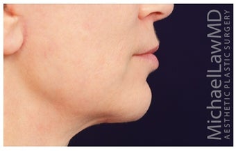 Fat Transfer after 1204853