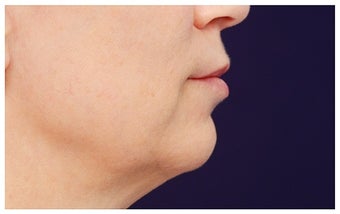 Fat Transfer before 1204853