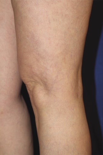 spider vein treatments after 450610