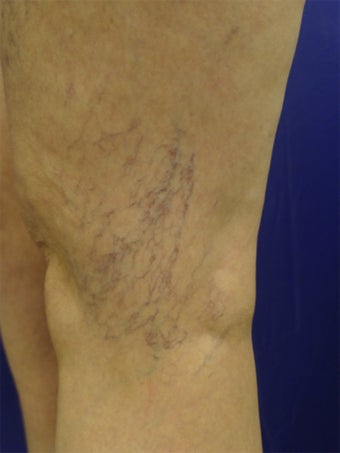 spider vein treatments before 450610