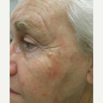 TCA Peel for sun damage and wrinkles before 1769769