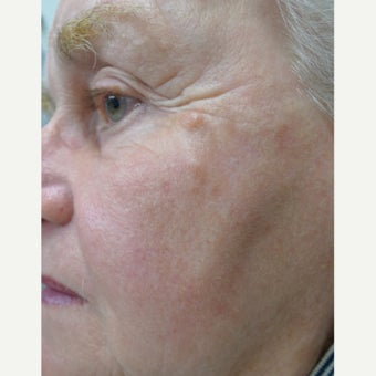 TCA Peel for sun damage and wrinkles after 1769769