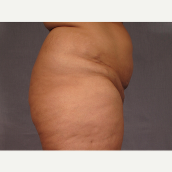 35-44 year old woman treated with Brazilian Butt Lift before 3308515