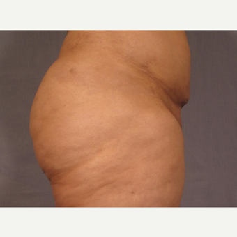 35-44 year old woman treated with Brazilian Butt Lift after 3308515