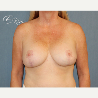 35-44 year old woman treated with Breast Lift with Implants after 3102611