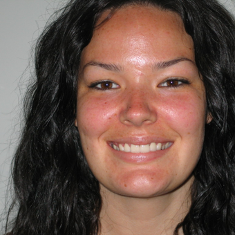 25-34 year old woman treated with Porcelain Veneers after 3770396
