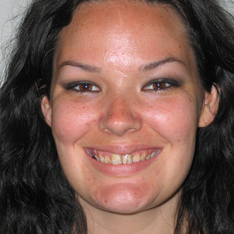 25-34 year old woman treated with Porcelain Veneers before 3770396