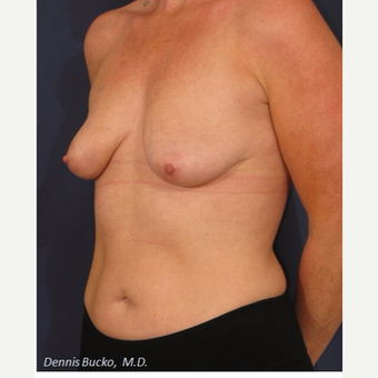 35-44 year old woman treated with Breast Augmentation before 3523293