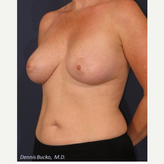 35-44 year old woman treated with Breast Augmentation after 3523293