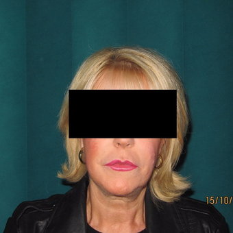 Advanced Mini Facelift Treatment before 3139797