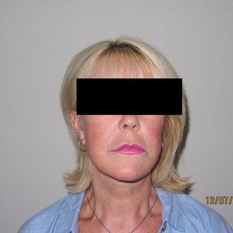 Advanced Mini Facelift Treatment after 3139797