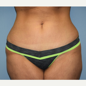 18-24 year old woman treated with Mini Tummy Tuck after 3703158