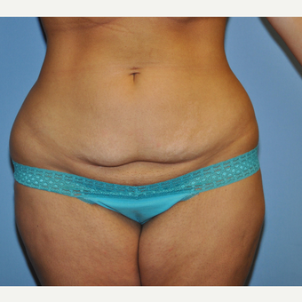 18-24 year old woman treated with Mini Tummy Tuck before 3703158