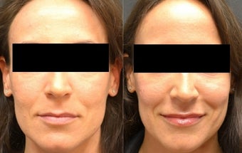 Restylane Filler to Cheeks and Lips before 1306505