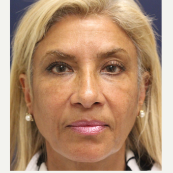55-64 year old woman treated with Bellafill after 3243128