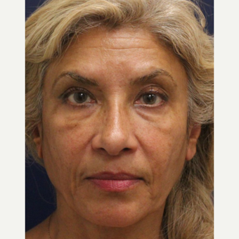 55-64 year old woman treated with Bellafill before 3243128