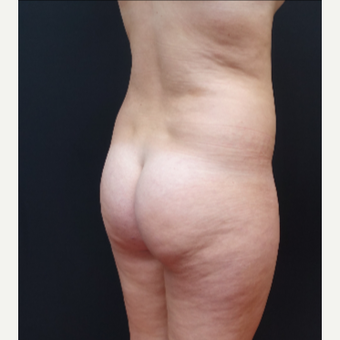 18-24 year old woman treated with Brazilian Butt Lift before 3315461