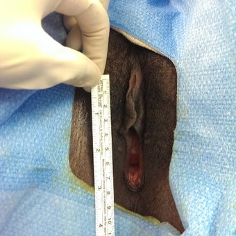 35-44 year old woman treated with Vaginal Rejuvenation before 2008017