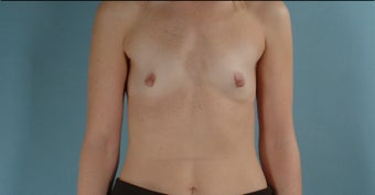 38 Year Old Woman Submuscular Breast Implants before 1000733