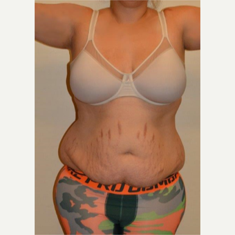 25-34 year old woman treated with Tummy Tuck before 3658508