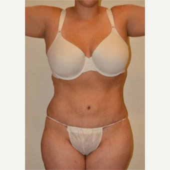 25-34 year old woman treated with Tummy Tuck after 3658508