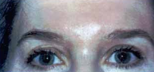 Dysport for frown lines, crows feet and forehead lines after 1394351