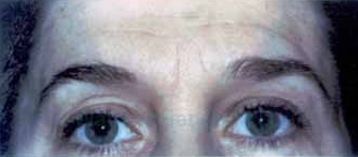 Dysport for frown lines, crows feet and forehead lines before 1394351