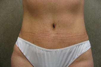 C.L.A.S.S ® Tummy Tuck after 479023