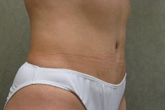 C.L.A.S.S ® Tummy Tuck 479023