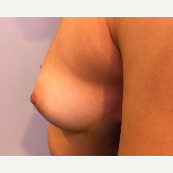 18-24 year old woman treated with Breast Augmentation before 3788728